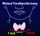 Small neck incision